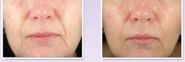 Juvederm® Injection